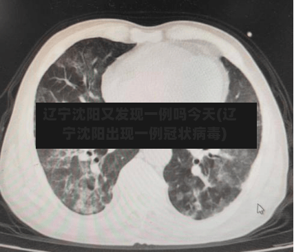 辽宁沈阳又发现一例吗今天(辽宁沈阳出现一例冠状病毒)