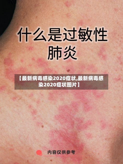 【最新病毒感染2020症状,最新病毒感染2020症状图片】-第2张图片