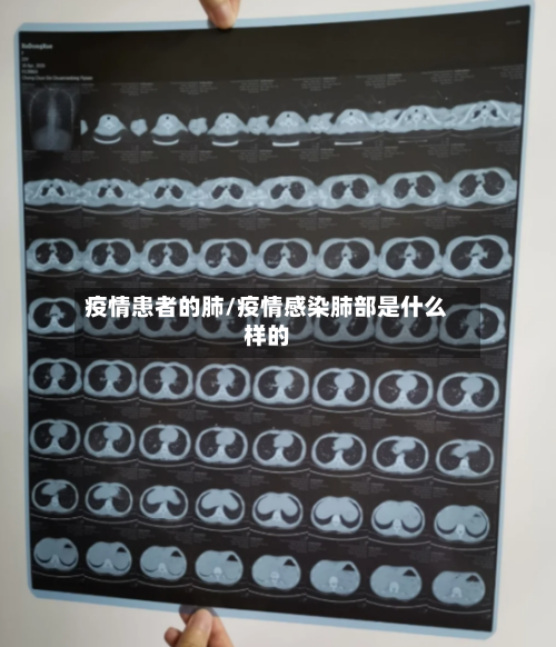 疫情患者的肺/疫情感染肺部是什么样的-第2张图片