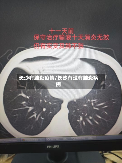 长沙有肺炎疫情/长沙有没有肺炎病例